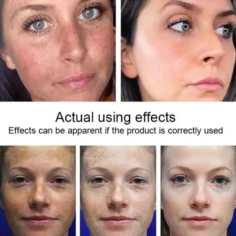 Powerful Spot-removing Whitening Freckles Cream Remove Melasma Dark Spots Fade Pigmentation Acne Moisturizing Brighten Skin Care